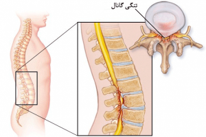 تنگی کانال نخاعی