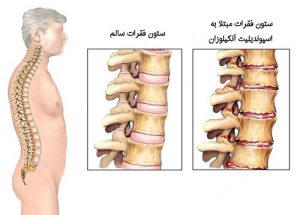 اسپوندیلیت آنکیلوزان