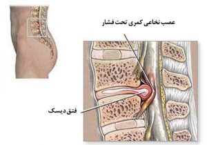 بهترین درمان دیسک کمر