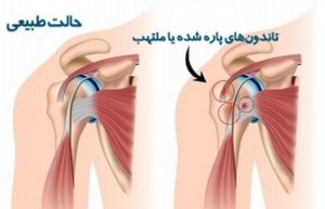 تاندونیت شانه