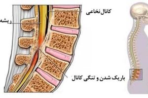تنگی کانال نخاع