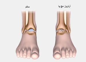 آرتروز مچ پا